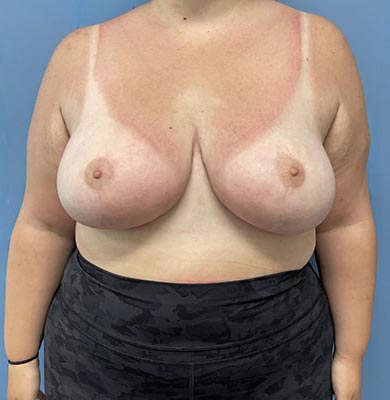 Breast Reduction before and after - after