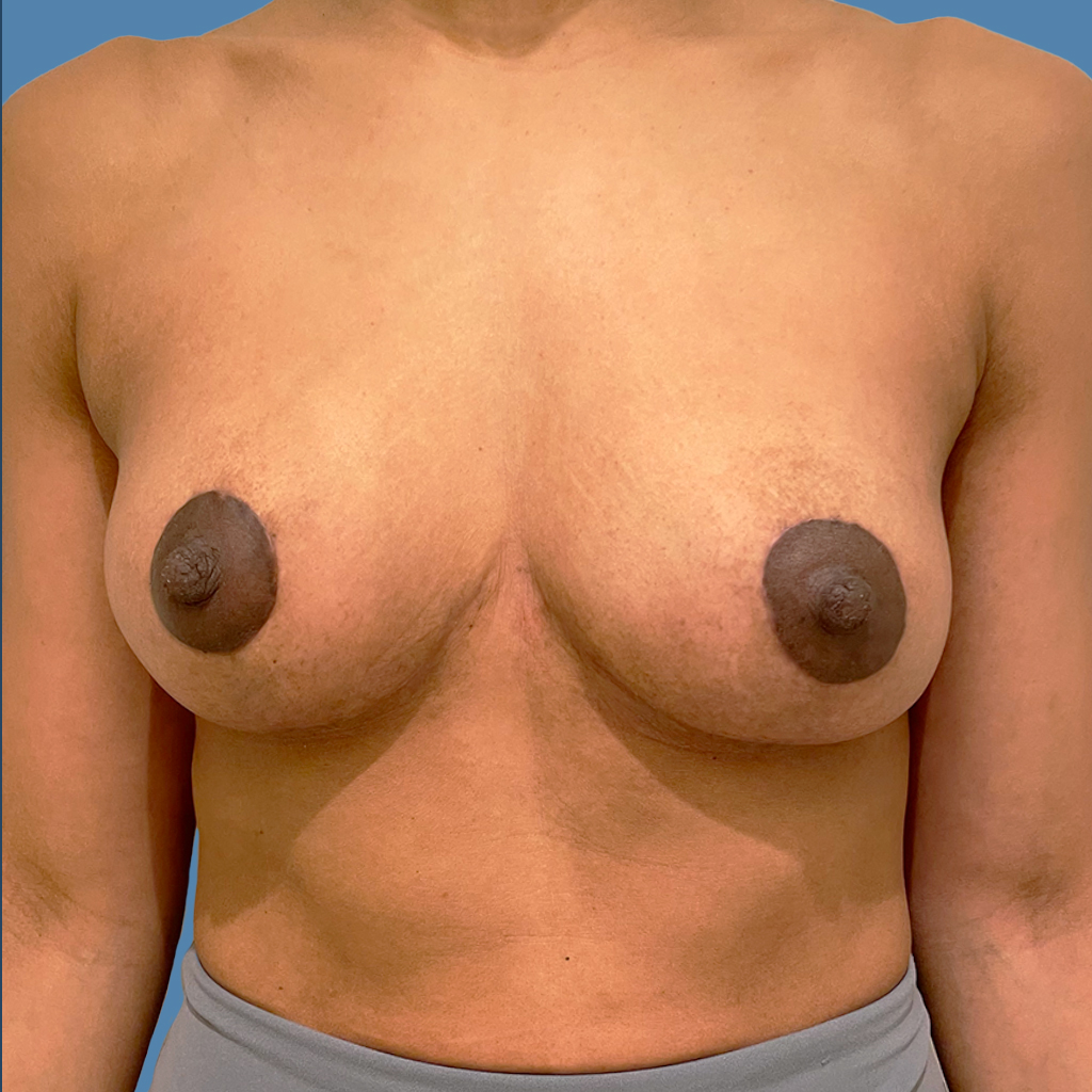 Breast Augmentation before and after - after