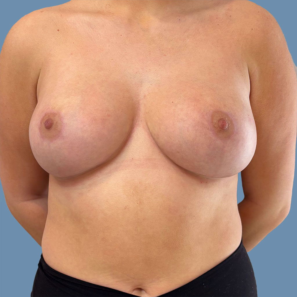Breast Reduction before and after - after
