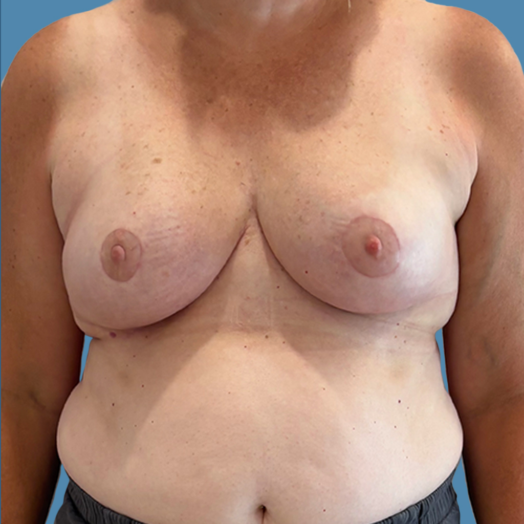 Breast Reduction before and after - after