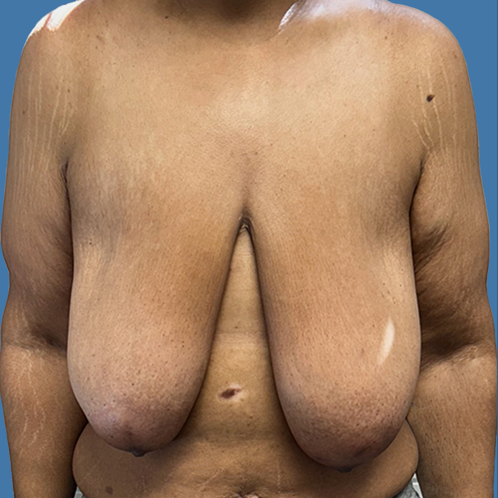 Breast Reduction before and after - before