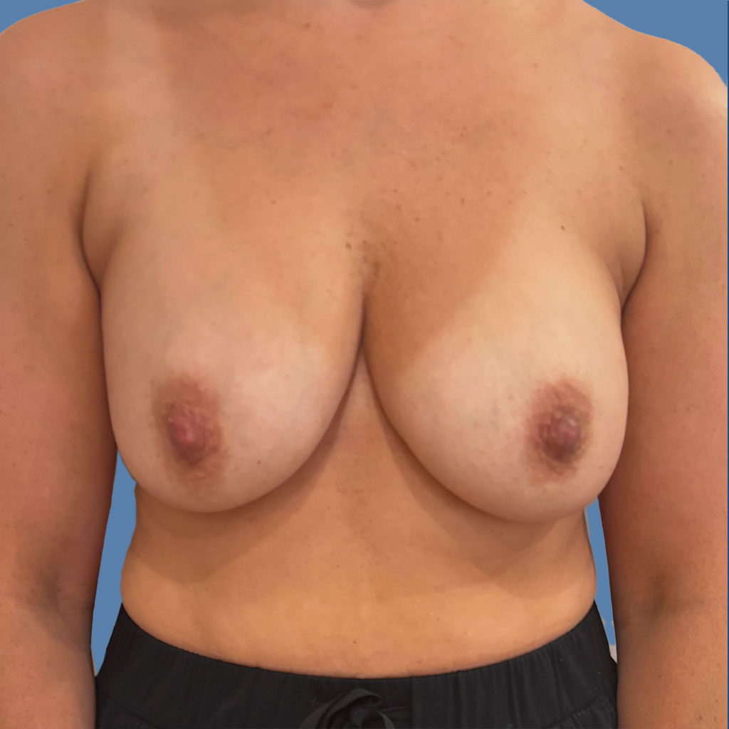 Breast Lift before and after - before