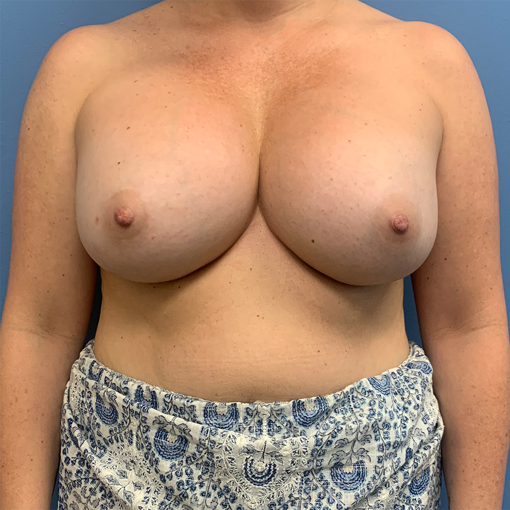 Breast Augmentation before and after - before
