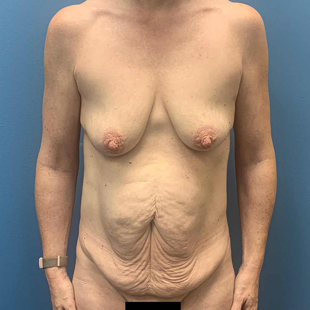Mommy Makeover before and after - before