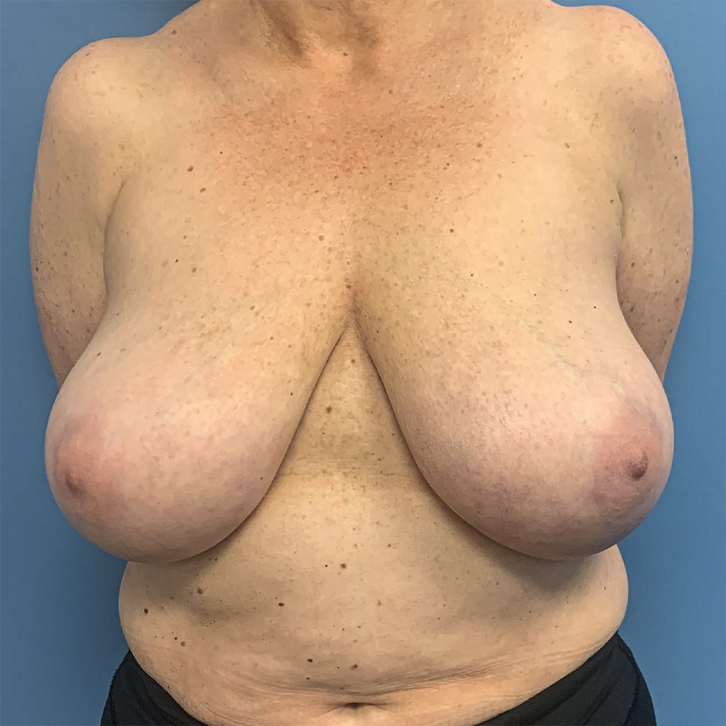 Breast Reduction before and after - before