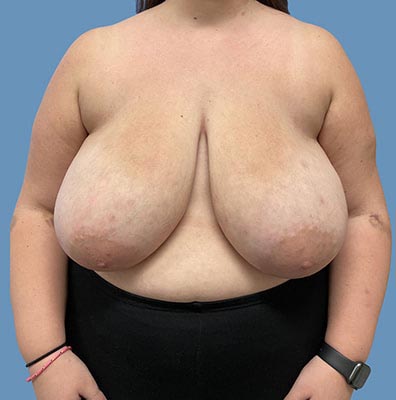 Breast Reduction before and after - before