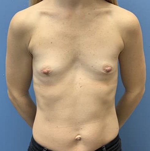 Breast Augmentation before and after - before