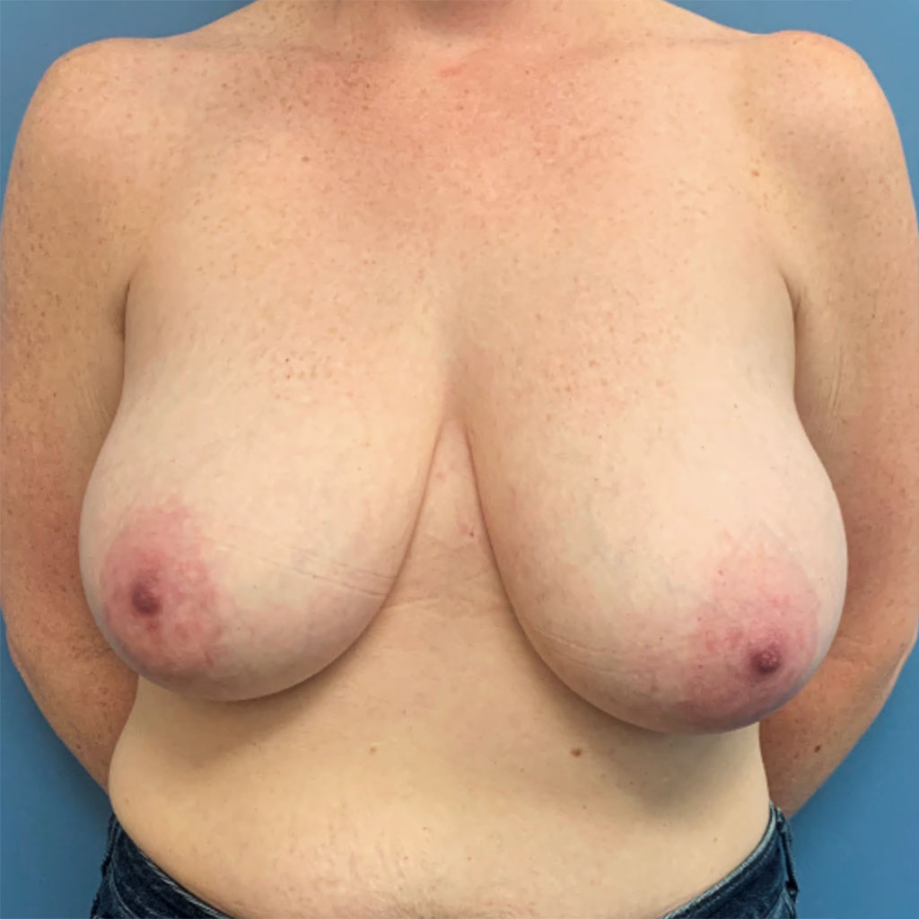 Breast Lift before and after - before