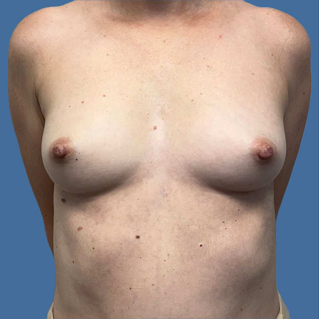 Breast Augmentation before and after - before