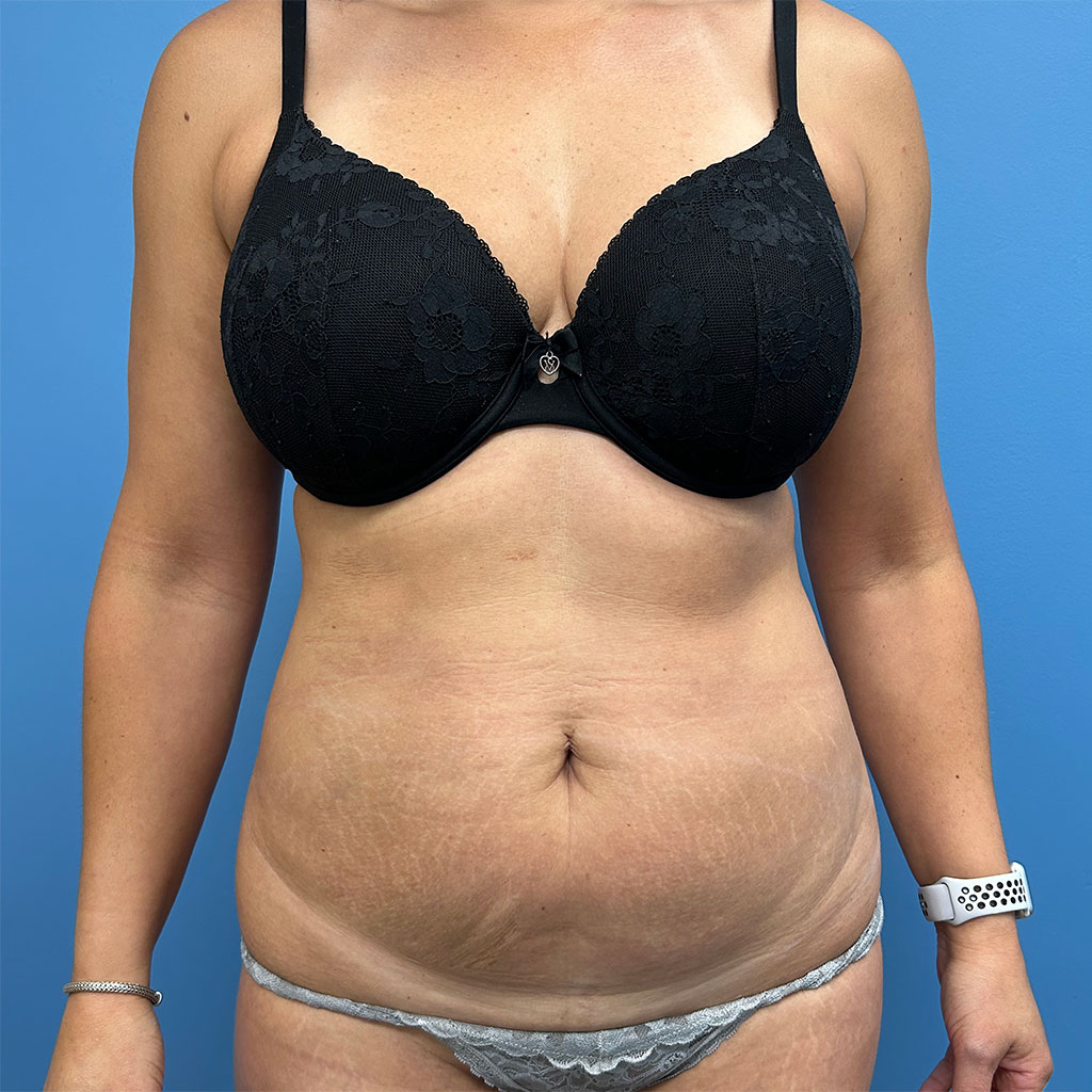 Mommy Makeover before and after - before