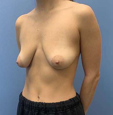 Breast Lift before and after - before