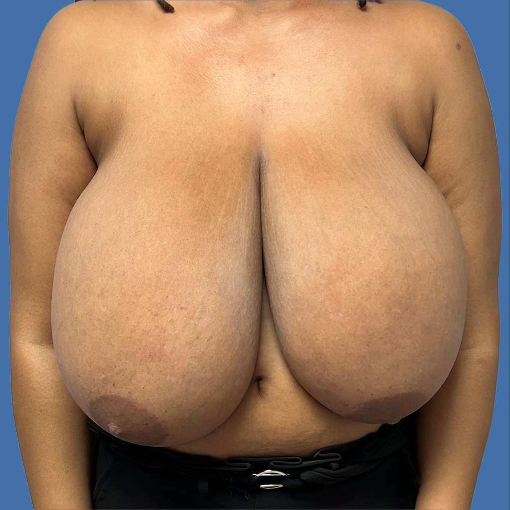 Breast Reduction before and after - before