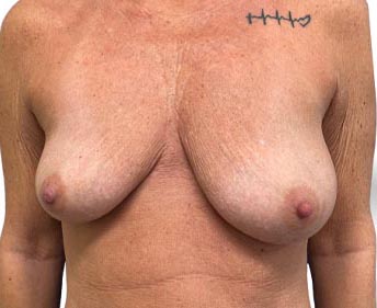 Breast Lift before and after - before
