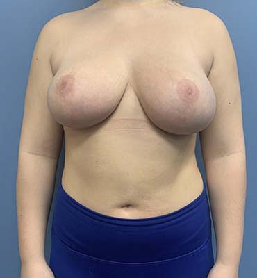 Breast Lift before and after - before