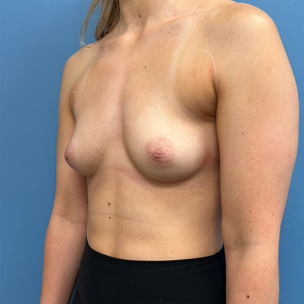 Breast Augmentation before and after - before
