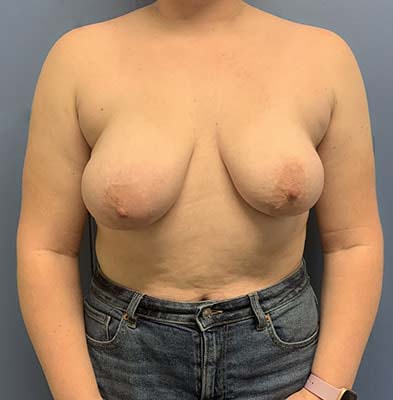 Breast Lift before and after - before