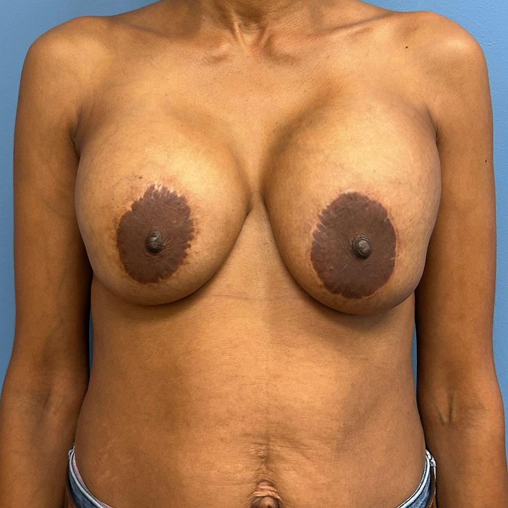 Breast Augmentation before and after - before