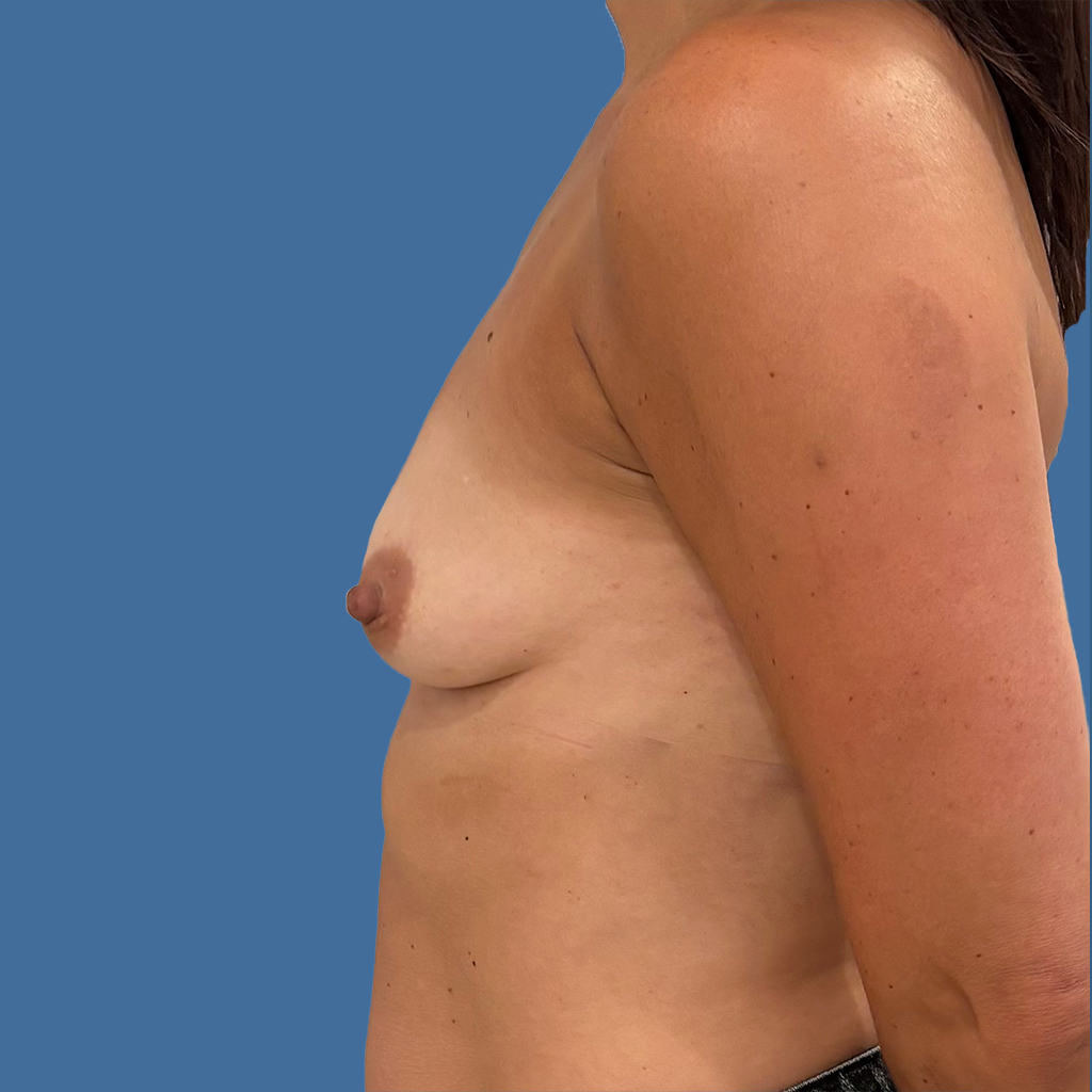 Breast Augmentation before and after - before