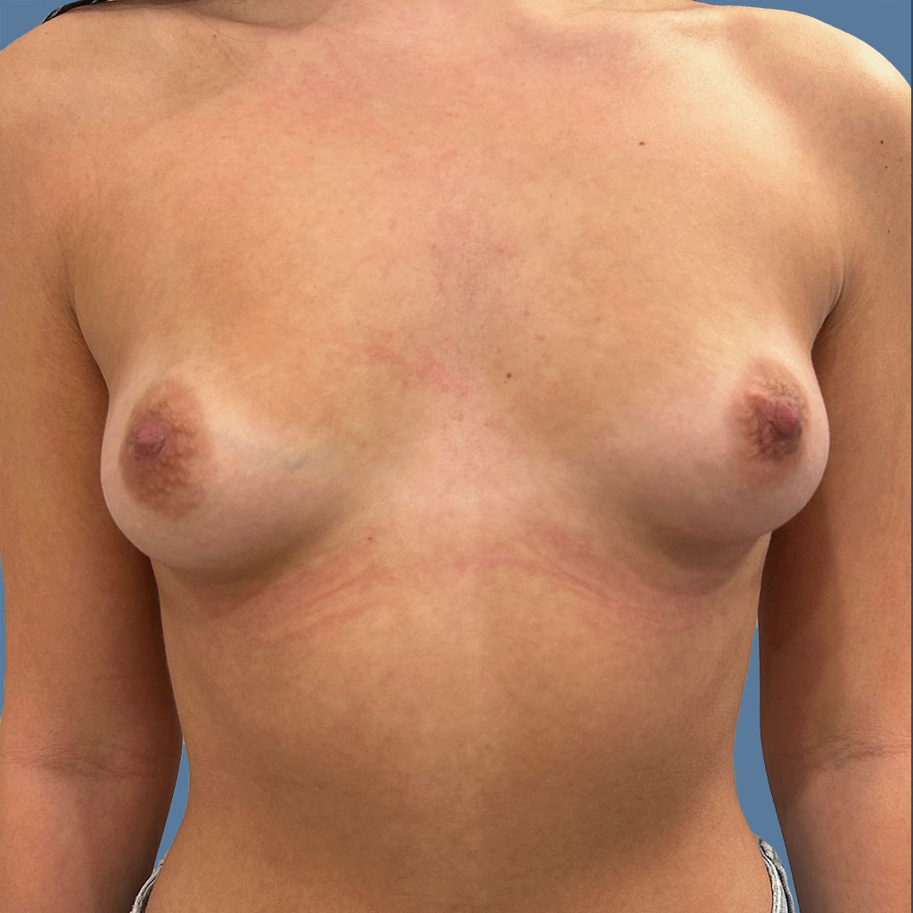 Breast Augmentation before and after - before