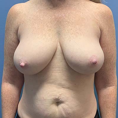 Breast Lift before and after - before