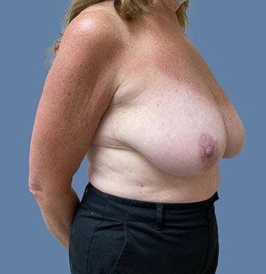 Breast Lift before and after - before
