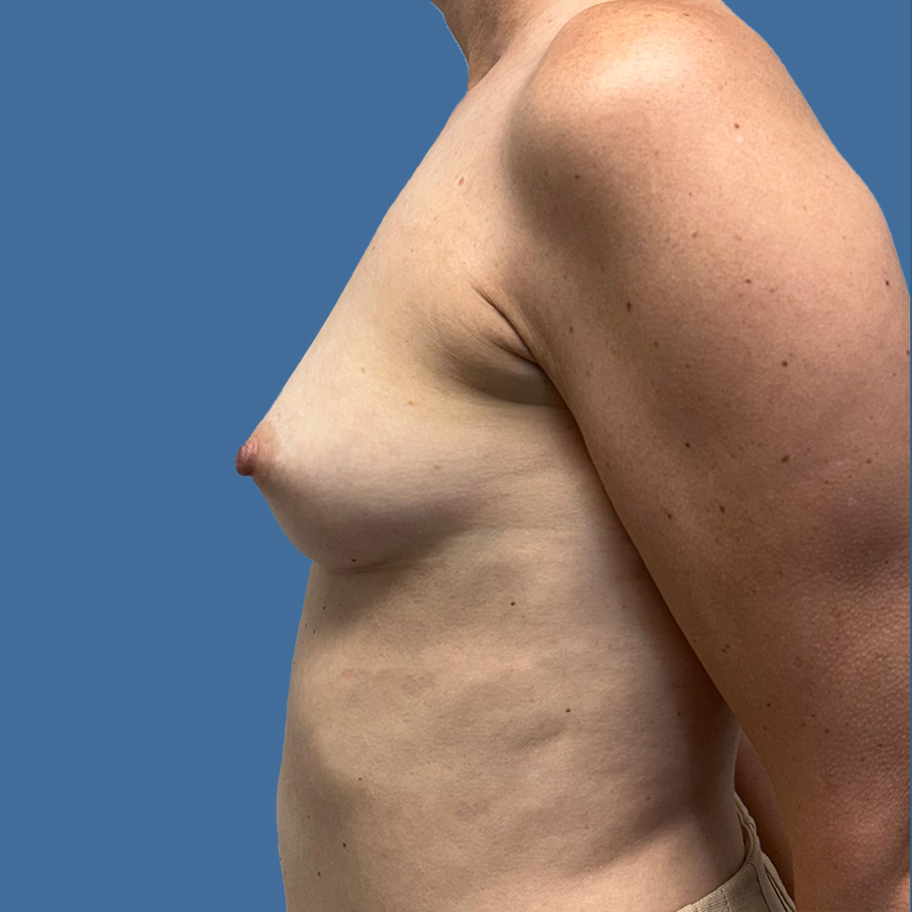 Breast Augmentation before and after - before