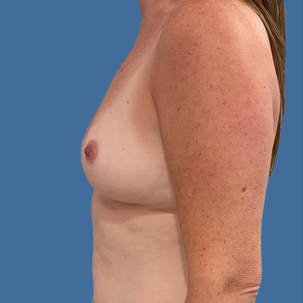 Breast Augmentation before and after - before