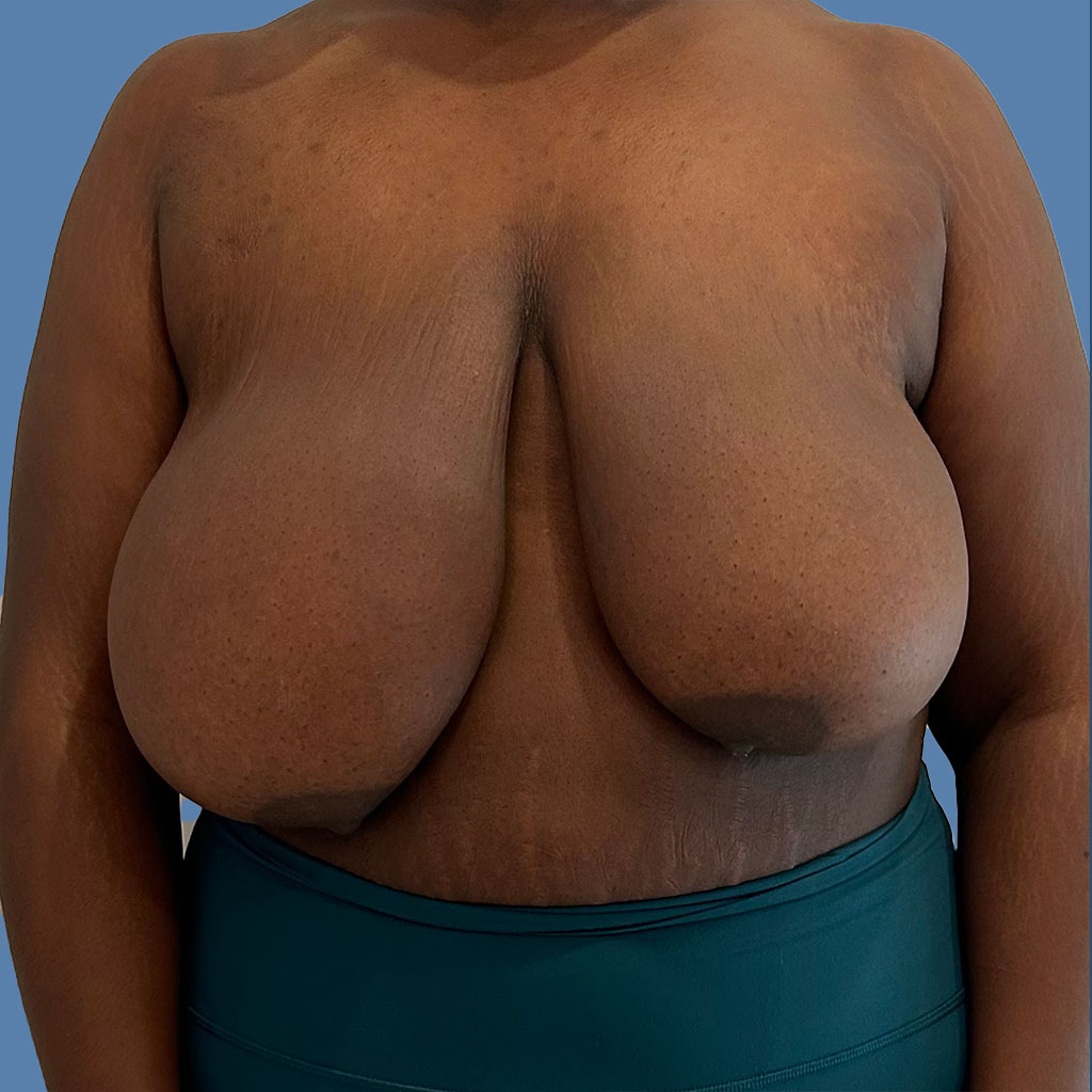 Breast Reduction before and after - before