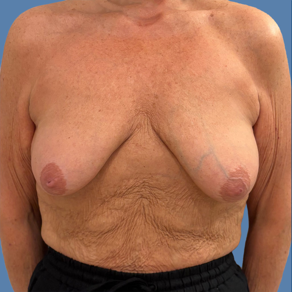 Breast Lift before and after - before