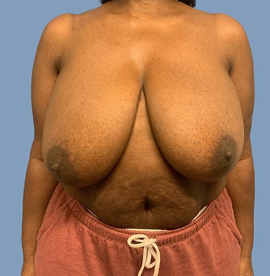 Breast Reduction before and after - before