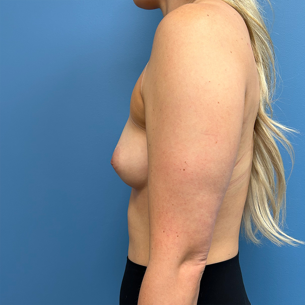 Breast Augmentation before and after - before