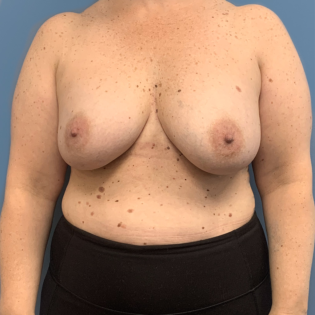 Breast Augmentation before and after - before