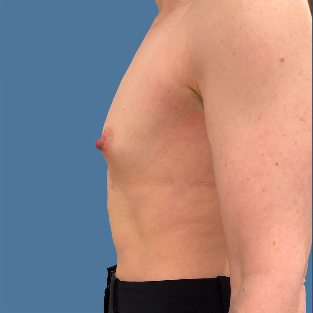 Breast Augmentation before and after - before