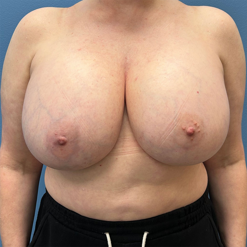 Breast Augmentation before and after - before