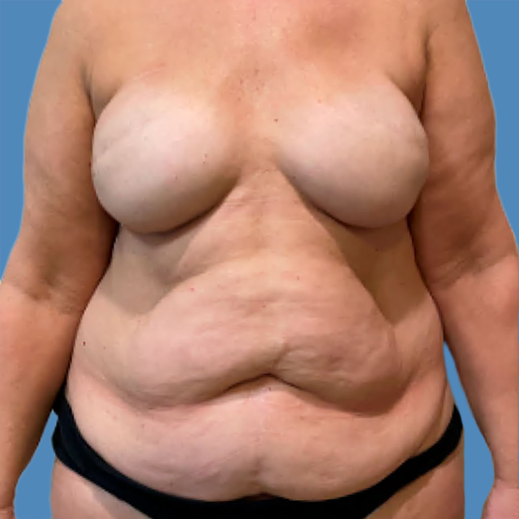 Procedure before and after - before