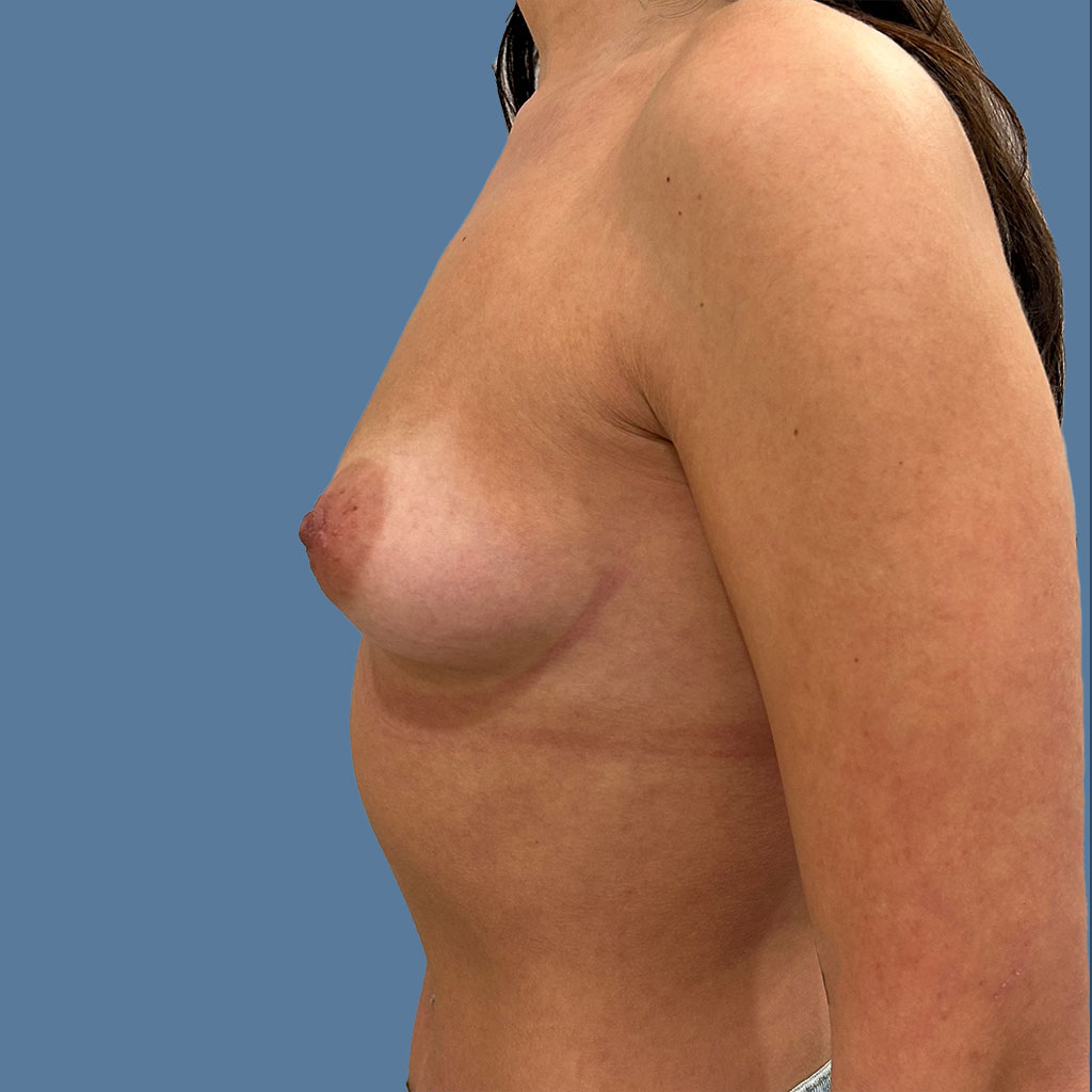 Breast Augmentation before and after - before