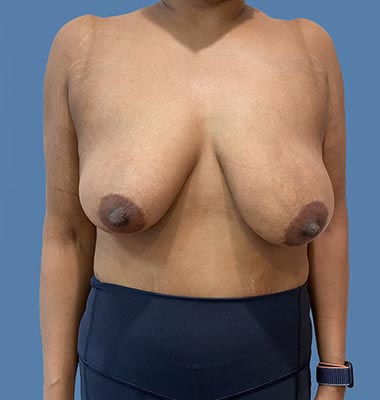 Breast Lift before and after - before