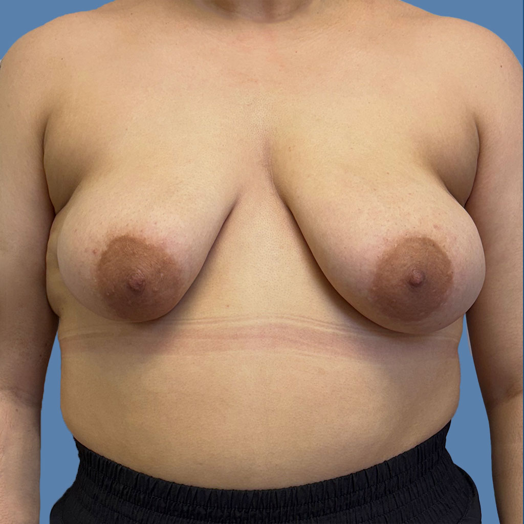 Breast Lift before and after - before