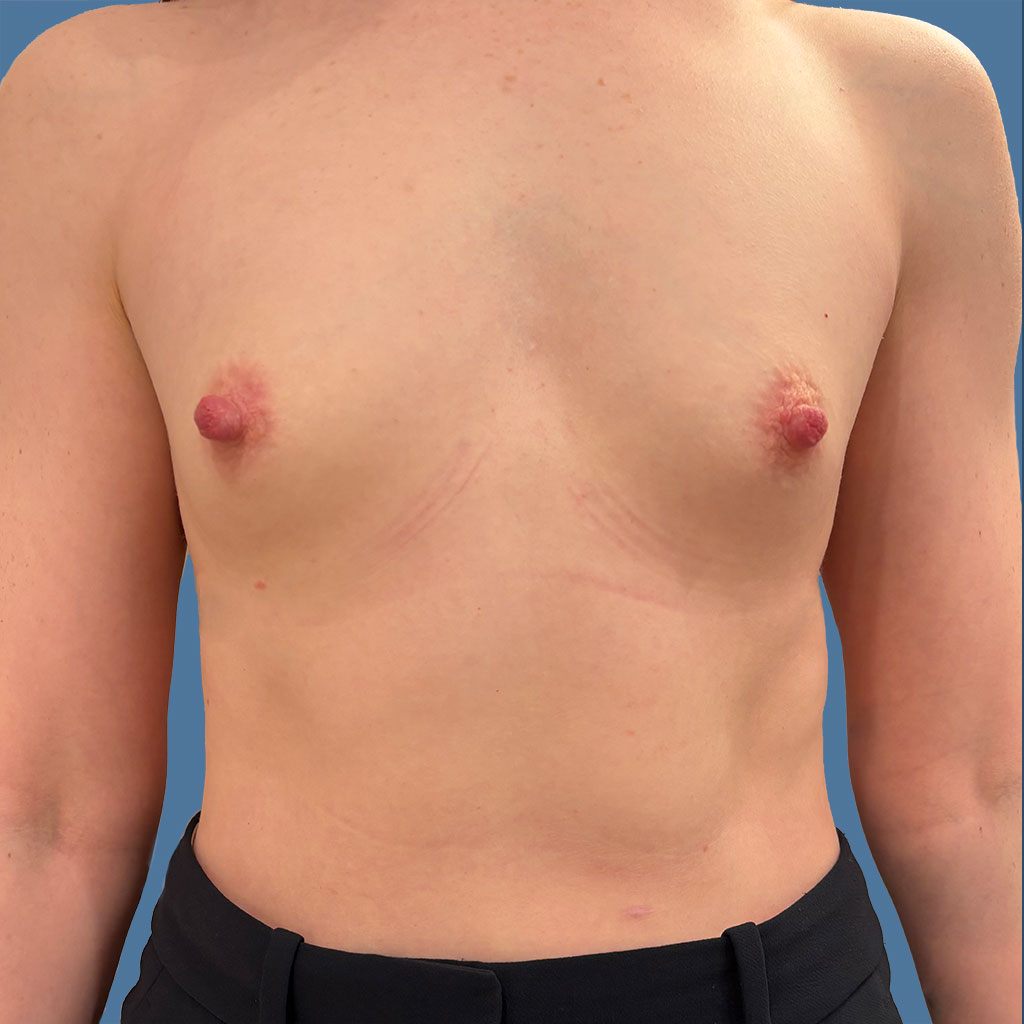 Breast Augmentation before and after - before