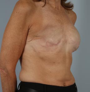 Breast Revision before and after - before
