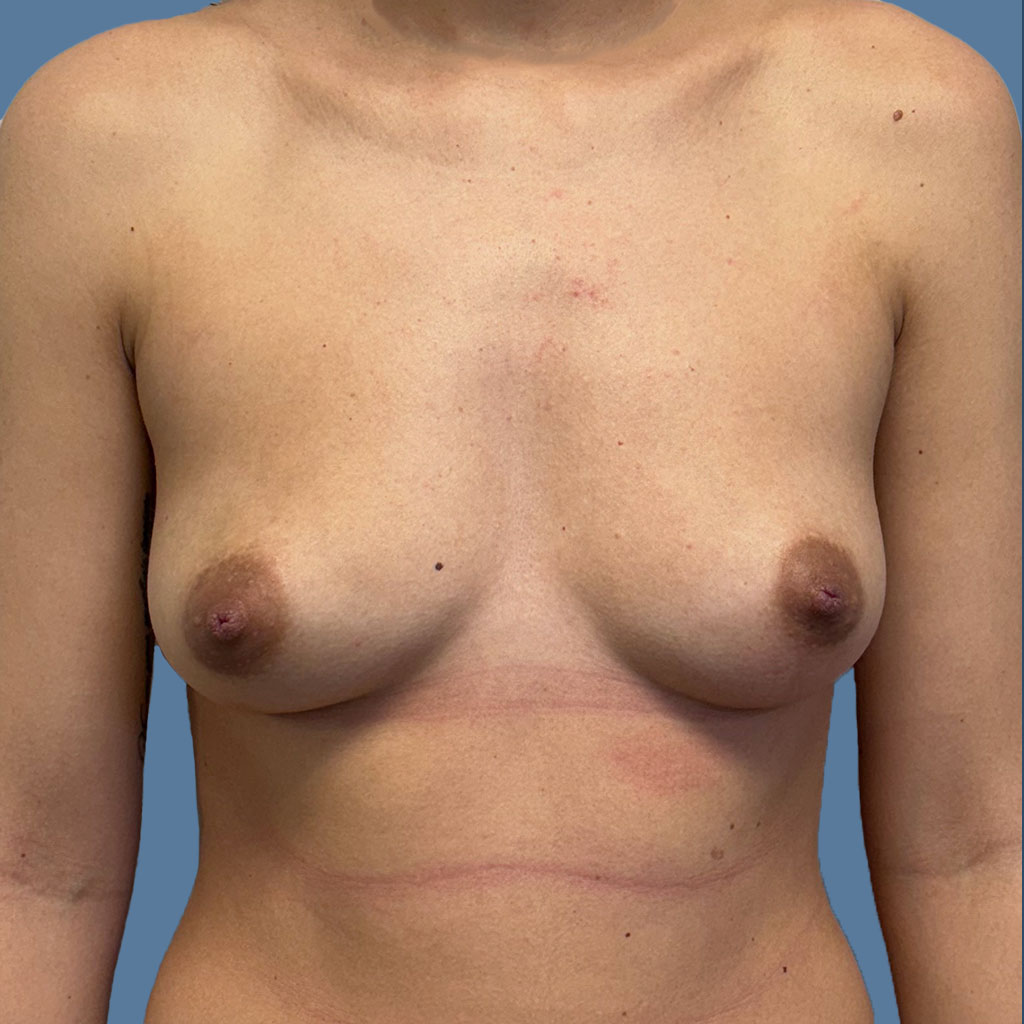 Breast Augmentation before and after - before