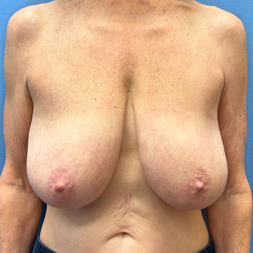 Breast Lift before and after - before