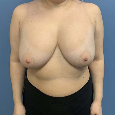 Breast Lift before and after - before