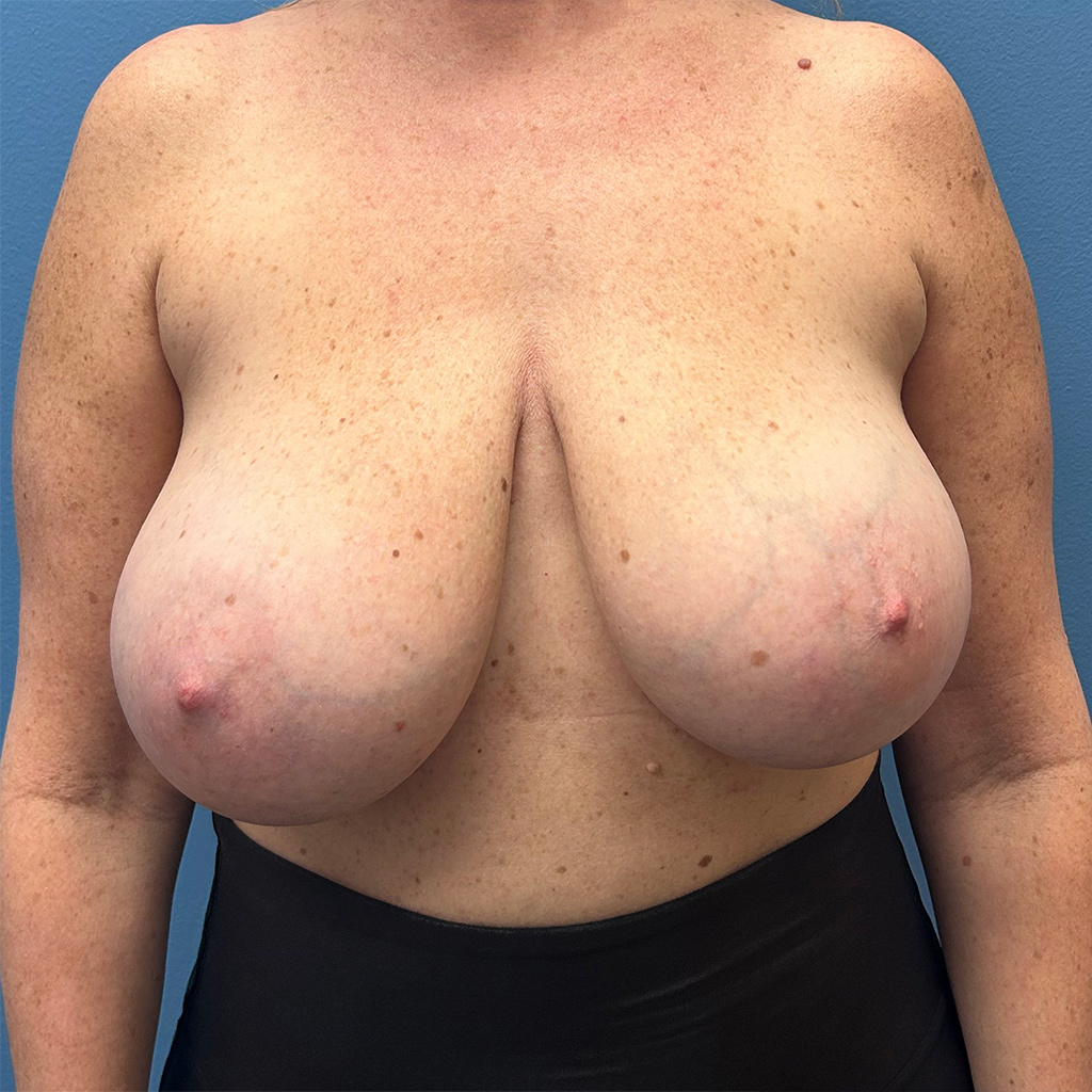 Breast Reduction before and after - before