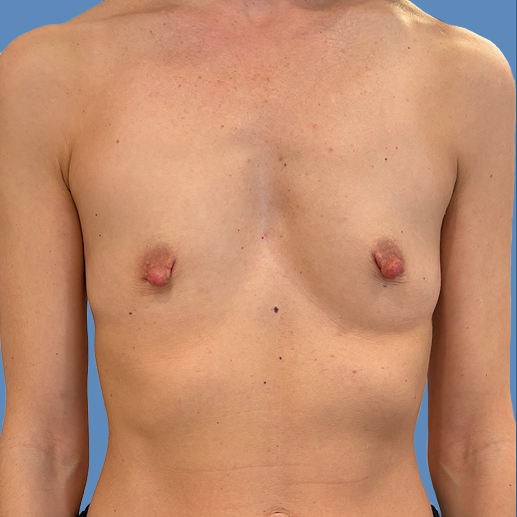 Breast Augmentation before and after - before