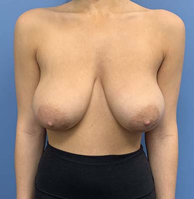 Breast Lift before and after - before