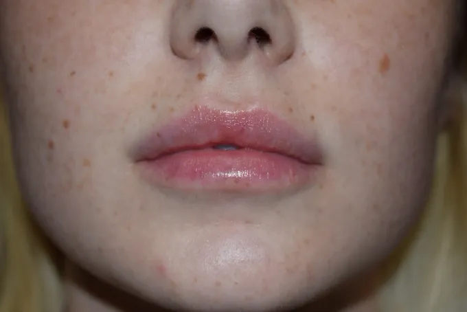 Procedure before and after - after