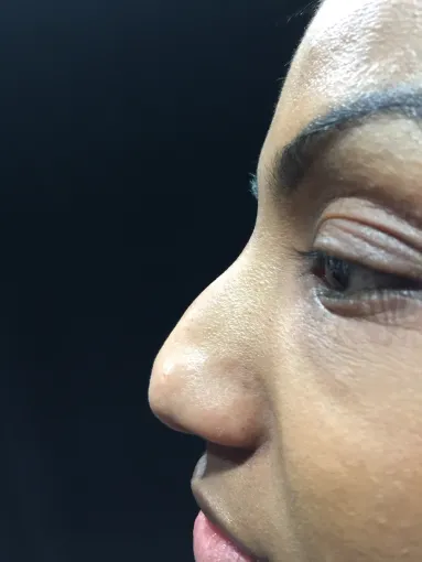 Procedure before and after - after