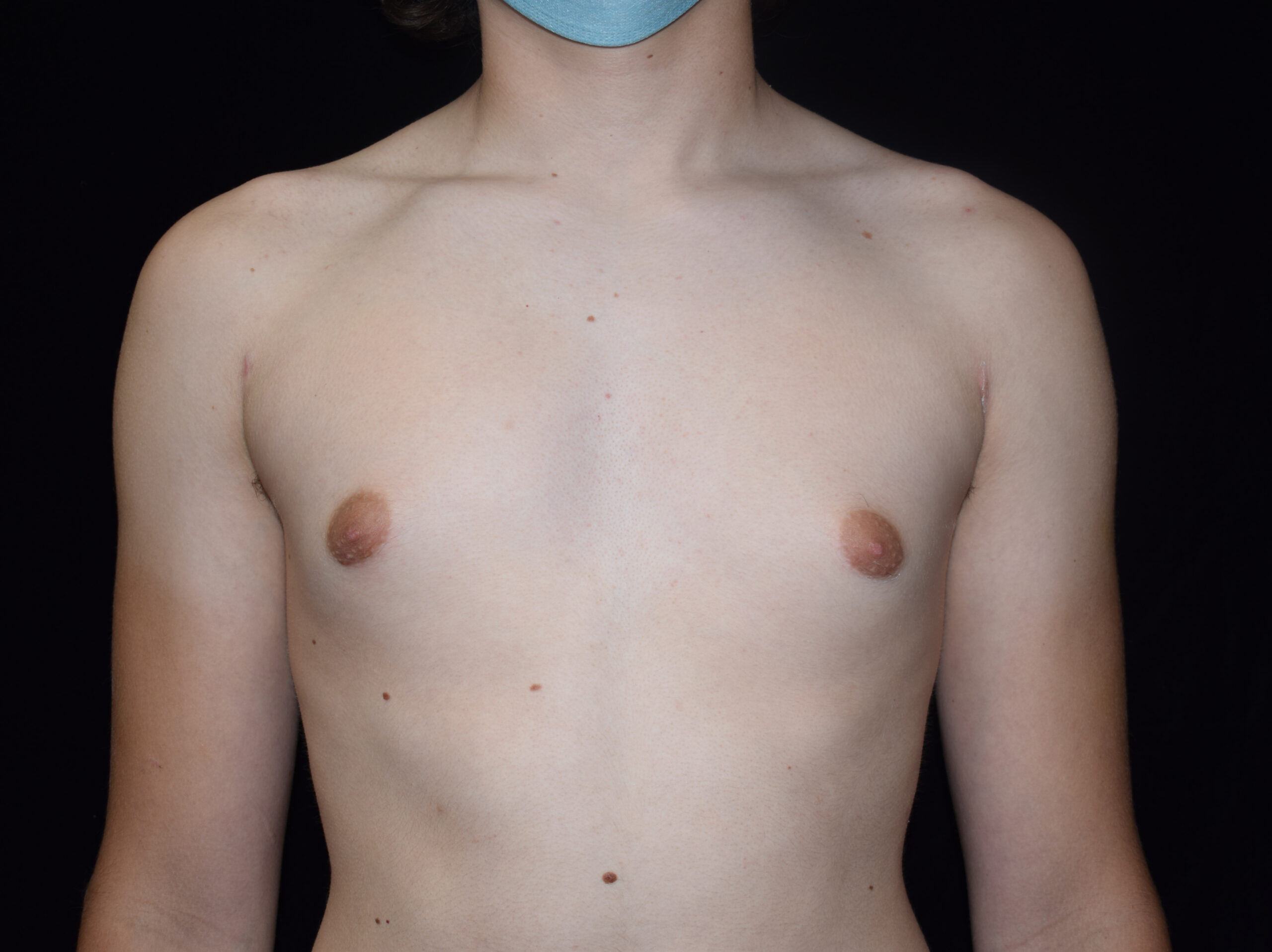 Procedure before and after - after