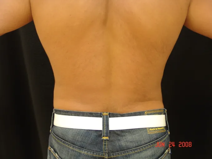 Liposuction before and after - after